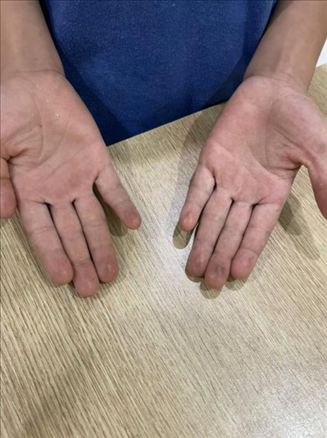 9歲小學(xué)生長(zhǎng)期拍煙卡，手部粗糙長(zhǎng)繭。受訪者供圖